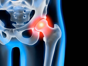Causes of Hip Pain